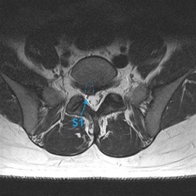 Does Sciatica Show Up on MRI? Exploring the Intersection of Pain and Imaging